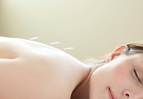 Acupuncture